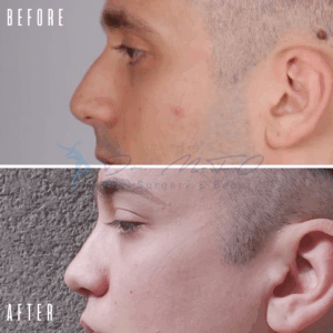 Ein Vorher-Nachher-Vergleich der Nase eines Mannes im Seitenprofil. Das Vorher-Bild zeigt eine Nase mit einem auffälligen Höcker, während das Nachher-Bild eine glattere, feinere Nase nach einem Eingriff zeigt.