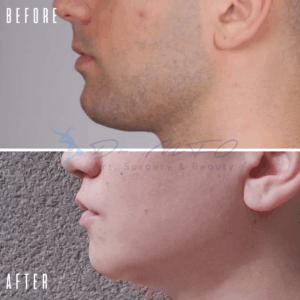 Vorher-Nachher-Fotos zeigen die Ergebnisse eines kosmetischen Eingriffs im Kinn- und Halsbereich eines Mannes. Das Vorher-Bild zeigt einen Mann mit Doppelkinn, während das Nachher-Bild denselben Mann mit einem definierteren Kinn und einem reduzierten Doppelkinn zeigt, was auf den Erfolg des Eingriffs hindeutet.