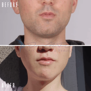 Vorher-Nachher-Foto des Gesichts eines Mannes, das Veränderungen in seinem Aussehen hervorhebt. Das Bild stammt von „Dr. MFO – Art, Beauty & Skin“.