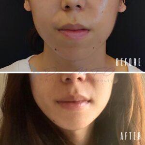 Vorher-Nachher-Vergleich des Gesichts eines Patienten mit den Ergebnissen eines kosmetischen Eingriffs. Das Vorher-Bild zeigt das Gesicht mit sichtbaren Schönheitsfehlern und ungleichmäßiger Textur, während das Nachher-Bild einen glatteren und klareren Teint zeigt.