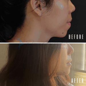 Ein Vorher-Nachher-Vergleich, der das Seitenprofil des Gesichts einer Person zeigt. Das Vorher-Bild zeigt die Person mit sichtbaren Hautproblemen, während das Nachher-Bild eine Verbesserung des Hautbildes zeigt.