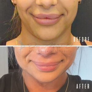 Ein Vorher-Nachher-Vergleich des Gesichts einer Person mit Fokus auf den Lippen. Das Vorher-Bild zeigt die Lippen mit einer auffälligen Narbe oder Unregelmäßigkeit. Das Nachher-Bild zeigt die Lippen nach einem Eingriff glatter und natürlicher. Die Bilder sind mit „VORHER“ und „NACHHER“ beschriftet, dazwischen steht der Text „Dr. MFO Kunst, Chirurgie & Schönheit“.