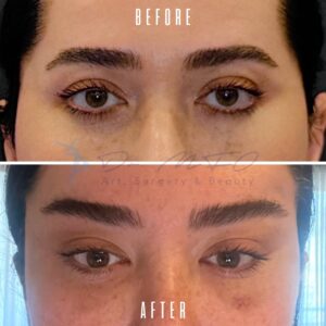 Ein Vorher-Nachher-Vergleich der Augen einer Person. Der Text „VORHER“ über dem ersten Bild und „NACHHER“ über dem zweiten Bild zeigt eine Transformation. Die Bilder zeigen Veränderungen an den Augenbrauen und im Augenbereich der Person, die wahrscheinlich auf einen kosmetischen Eingriff zurückzuführen sind.