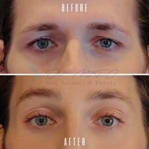 Vorher-Nachher-Vergleich der Augen einer Person, der die Veränderungen durch einen kosmetischen Eingriff hervorhebt. Das Bild stammt von Dr. MFO Art, Surgery & Beauty.