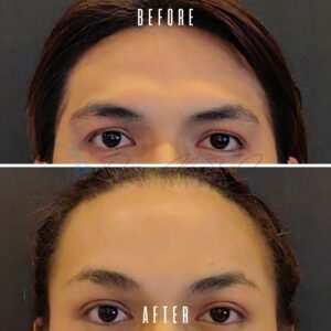 Ein Vorher-Nachher-Vergleich, der die Ergebnisse eines kosmetischen Eingriffs an der Stirn einer Person zeigt. Das Vorher-Bild zeigt die Stirn mit sichtbaren Linien und Fältchen, während das Nachher-Bild eine glattere Stirn mit reduzierten Alterserscheinungen zeigt.