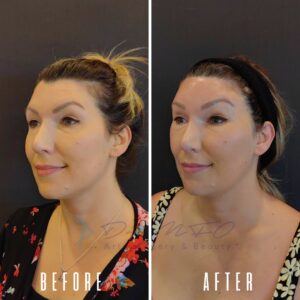 Ein Vorher-Nachher-Vergleich des Gesichts einer Frau nach einer Schönheitsbehandlung. Das Vorher-Bild zeigt sie mit sichtbaren Schönheitsfehlern und ungleichmäßigem Hautton, während das Nachher-Bild eine glattere und reinere Haut zeigt.