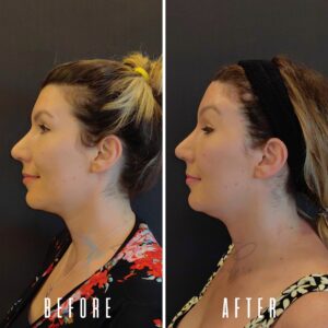 Ein Vorher-Nachher-Vergleich des Gesichts einer Frau, der Veränderungen ihrer Gesichtszüge zeigt. Das Vorher-Bild zeigt sie mit einer weniger ausgeprägten Kieferpartie, während das Nachher-Bild eine ausgeprägtere und feinere Kieferpartie zeigt.