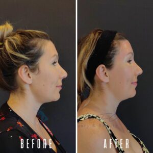 Ein Vorher-Nachher-Vergleich des Seitenprofils einer Frau nach einer Nasenkorrektur. Das Vorher-Bild zeigt ihre Nase mit einem leichten Höcker und einer breiteren Spitze, während das Nachher-Bild eine glattere, feinere Nase mit einer schmaleren Spitze zeigt.