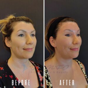 Ein Vorher-Nachher-Vergleich des Gesichts einer Frau nach einem kosmetischen Eingriff. Das Vorher-Bild zeigt sie mit sichtbaren Schönheitsfehlern und ungleichmäßigem Hautton, während das Nachher-Bild eine glattere und reinere Haut zeigt.