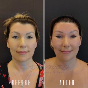 Vorher-Nachher-Vergleich des Gesichts einer Frau, der die Veränderungen zeigt, die in einer auf Kunst, Chirurgie und Schönheit spezialisierten Klinik vorgenommen wurden. Das Vorher-Bild zeigt die Frau mit sichtbaren Gesichtszügen, während das Nachher-Bild Verbesserungen oder Behandlungen an ihrem Gesicht hervorhebt.