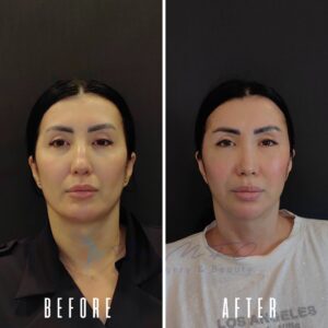 Vorher-Nachher-Vergleich des Gesichts einer Frau. Verdeutlicht werden Veränderungen, die wahrscheinlich auf einen kosmetischen Eingriff oder Make-up zurückzuführen sind. Das Vorher-Bild zeigt sie mit minimalem Make-up, während das Nachher-Bild sie mit stärkerem Make-up zeigt, was möglicherweise auf eine Veränderung ihres Aussehens hindeutet.