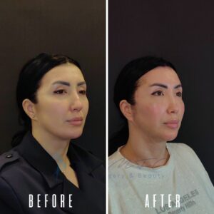 Vorher-Nachher-Foto einer Frau, die sich einem kosmetischen Eingriff, wahrscheinlich einer Nasenkorrektur, unterzogen hat und deutliche Veränderungen ihrer Nasenform und ihres Gesichtsausdrucks zeigt.