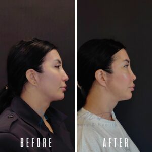 Ein Vorher-Nachher-Vergleichsbild zeigt das Profil einer Frau. Das Vorher-Bild zeigt ihr Profil mit zurückgekämmten Haaren und einem dunklen Oberteil. Das Nachher-Bild zeigt ihr Profil mit zurückgekämmten Haaren, einem hellen Oberteil und deutlichen Veränderungen ihrer Gesichtszüge.