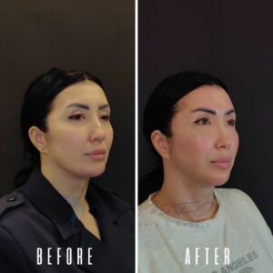 Vorher-Nachher-Foto einer Frau, die sich einem kosmetischen Eingriff unterzogen hat. Das Vorher-Bild zeigt sie mit vollem Gesicht, während das Nachher-Bild sie mit schmalerem Gesicht zeigt.