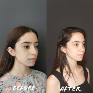 Avant Après FFS Galerie 1