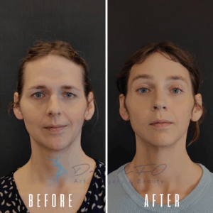 Avant Après FFS Galerie 19