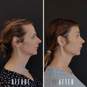 Avant Après FFS Galerie 20