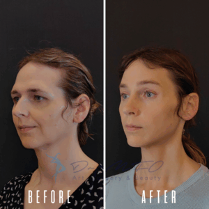 Avant Après FFS Galerie 21