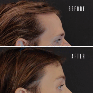 Avant Après FFS Galerie 22