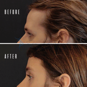 Avant Après FFS Galerie 23