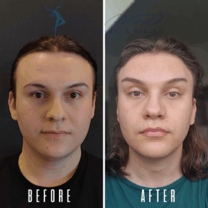 Avant Après FFS Galerie 24