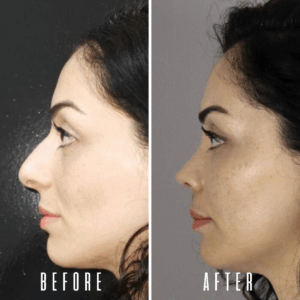 Avant Après Galerie FFS 25