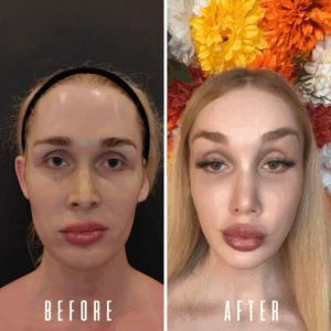 Avant Après FFS Galerie 4