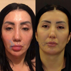 Avant Après FFS Galerie 5