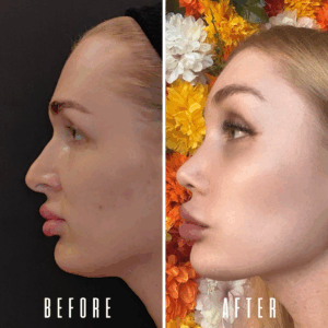 Avant Après FFS Galerie 6