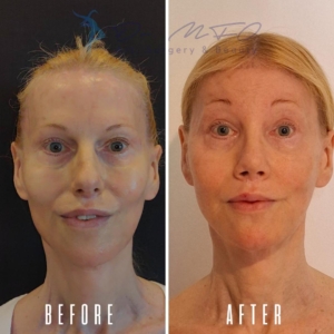 Avant Après FFS Galerie 7