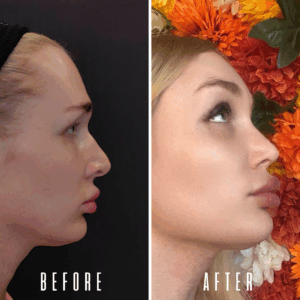 Avant Après FFS Galerie 8