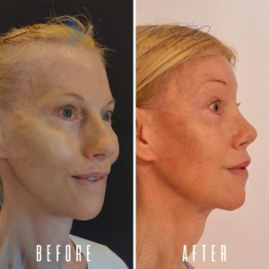 Avant Après FFS Galerie 9