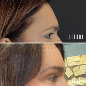 Avant Après FFS Galerie 10