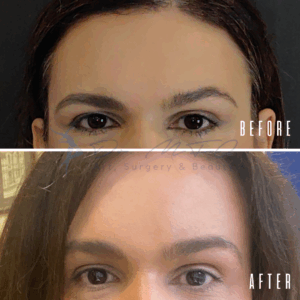 Avant Après FFS Galerie 12