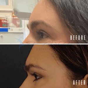 Avant Après FFS Galerie 14