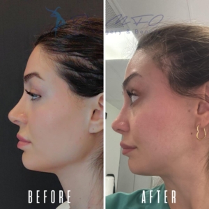 Avant Après FFS Galerie 15