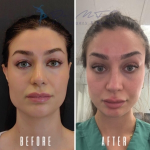 Avant Après FFS Galerie 17