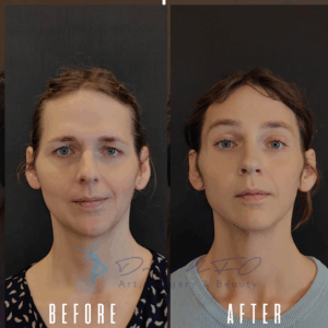 Avant Après FFS Galerie 18