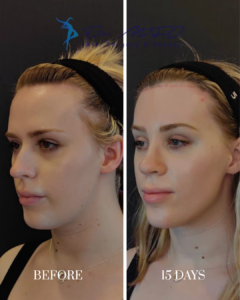 Before After FFS Gallery 42