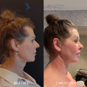 Before After FFS Gallery 25