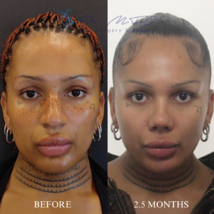 Before After FFS Gallery 27