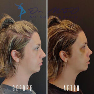 Before After FFS Gallery 28