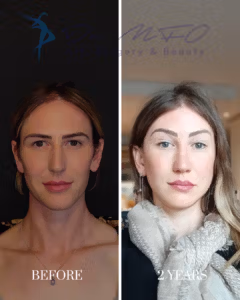 Феминизация лица