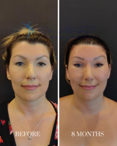 A before and after comparison of a woman's face, showing results 8 months after a cosmetic procedure.