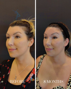 Before and after facial procedure results showing a patient's appearance before treatment and 8 months after treatment.