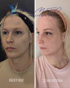 Before and 2 months after facial surgery results, showing the patient's transformation from a front and side profile view by Dr. MFO Surgery & Beauty.