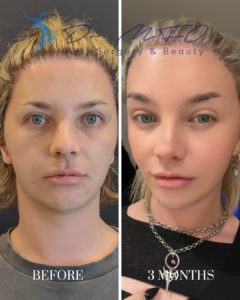 Before and 3 months after plastic surgery comparison showing facial rejuvenation by Dr. MFO Art, Surgery & Beauty.