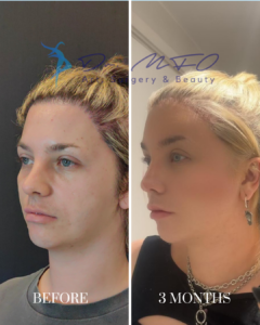 Before and 3 months after facial surgery results showing the patient's profile transformation by Dr. MFO Surgery & Beauty.