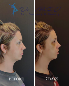 Before and after side profile comparison of a patient 7 days after facial surgery by Dr. MFO Art, Surgery & Beauty.