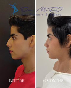 Before and 6 months after rhinoplasty surgery showing the side profile improvement by Dr. MFO.
